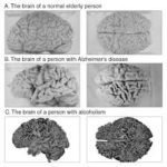 alcoholic brain, AD brain, normal brain